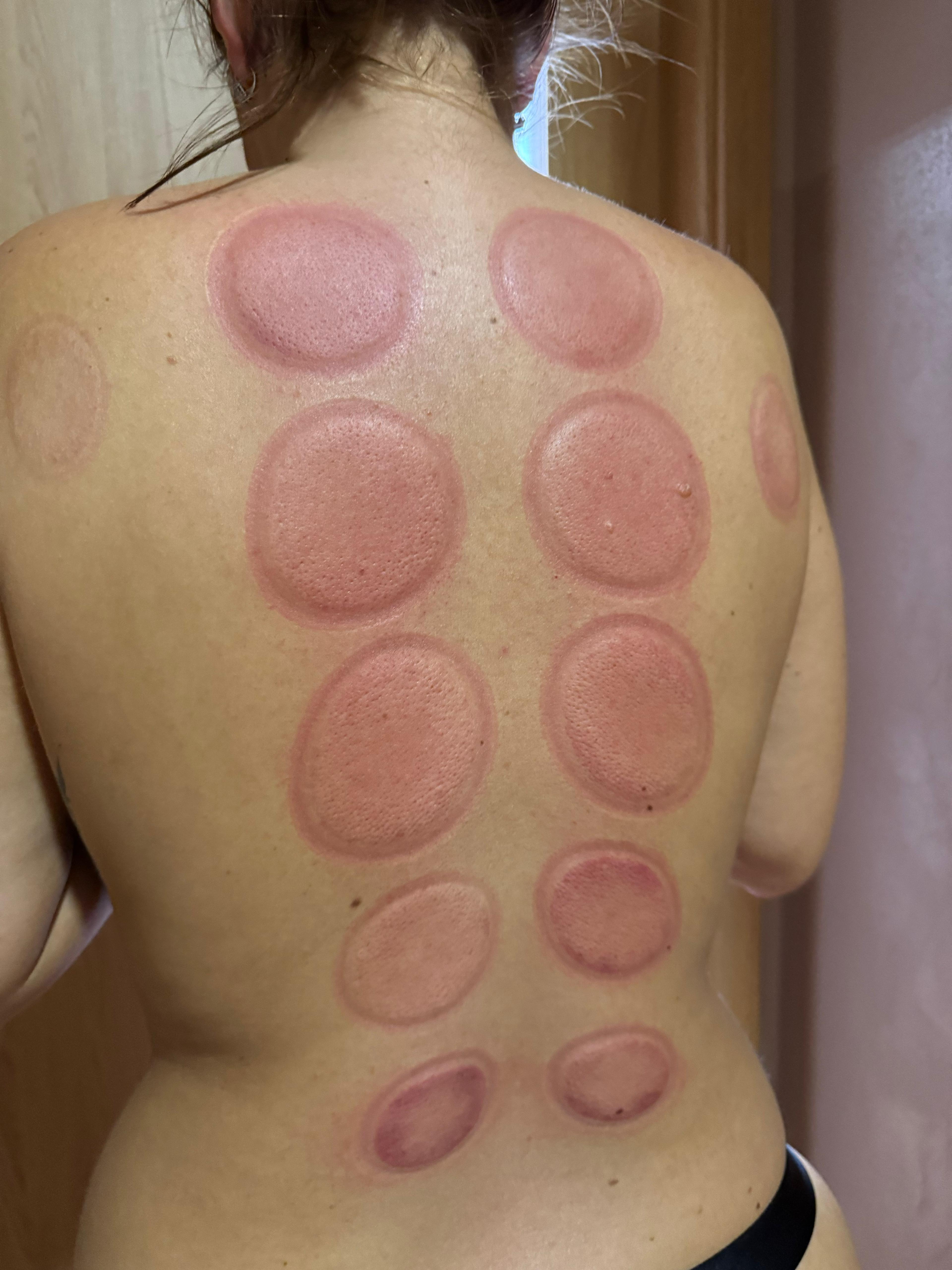 Detoxikační masáž skleněnými baňkami v Rstudiu Louny